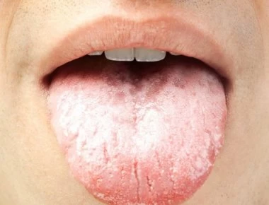 Αν δείτε αυτό στη γλώσσα σας πρέπει να πάτε αμέσως στο γιατρό!